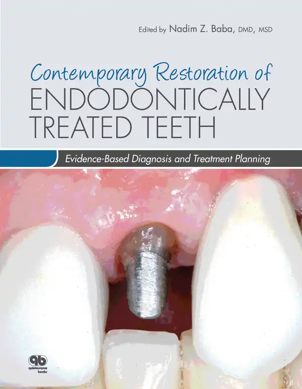 Contemporary Restoration of Endodontically Treated Teeth : Evidence-Based Diagnosis and Treatment Planning