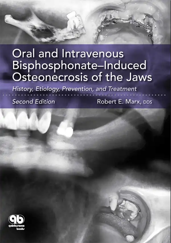 Oral and Intravenous Bisphosphonate–Induced Osteonecrosis of the Jaws : History, Etiology, Prevention, and Treatment, Second Edition