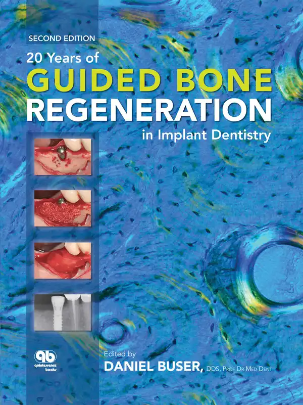 20 Years of Guided Bone Regeneration in Implant Dentistry : Second Edition