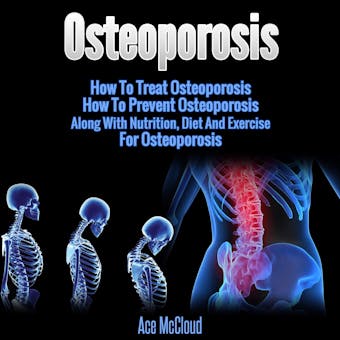 Osteoporosis: How To Treat Osteoporosis: How To Prevent Osteoporosis: Along With Nutrition, Diet And Exercise For Osteoporosis - Ace McCloud