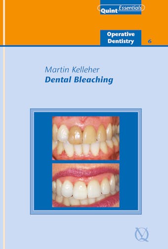 Dental Bleaching - Martin Kelleher