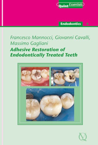 Adhesive Restoration of Endodontically Treated Teeth - Giovanni Cavalli, Massimo Gagliani, Francesco Mannocci